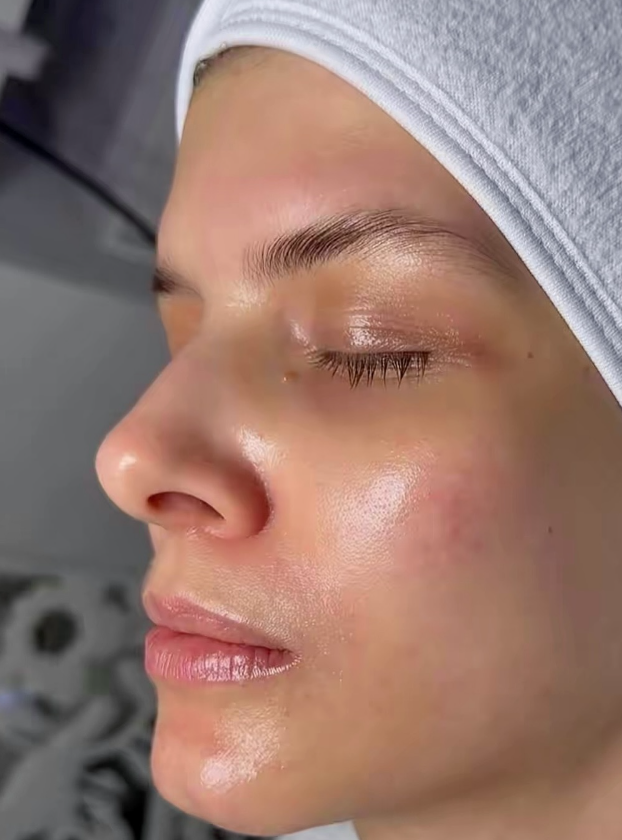 Haut nach dem Skin-Reset – Nahaufnahme Wange und Nase